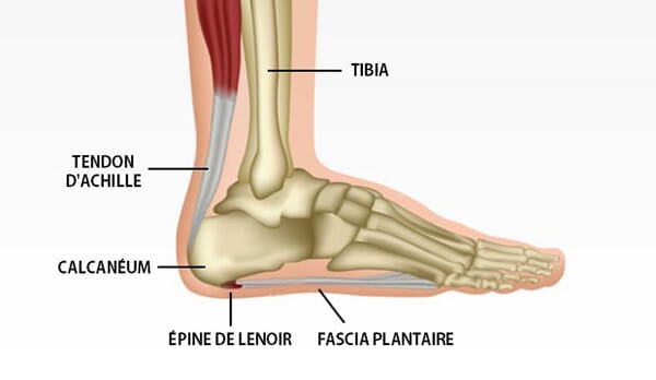 L Apon vrosite Plantaire Fasciite Plantaire Pathologie tr s